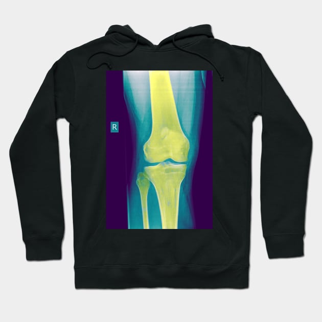 Knee x-ray (C022/3104) Hoodie by SciencePhoto